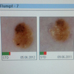 Digitales Hautkrebs-Screening